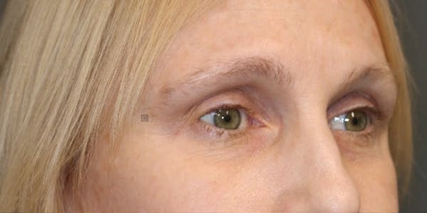  EnigmaLift - Upper Eyelid Surgery Before & After Gallery - Patient 123023711 - Image 9