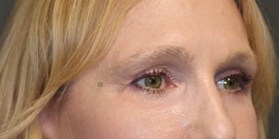 ÔPTIMized Laser Cocktail Before & After Gallery - Patient 123023715 - Image 10