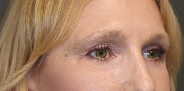 EnigmaLift - Eye Bag Removal Before & After Gallery - Patient 123023714 - Image 10