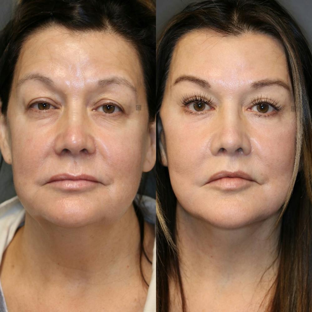 Eyelid Lift Before and After Photo Gallery, Golden, CO