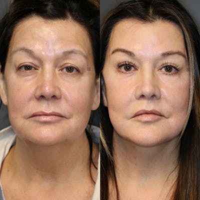 Before & After EnigmaLift Upper Eyelid Surgery