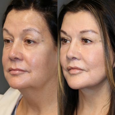Deep plane neck lift before and after picture