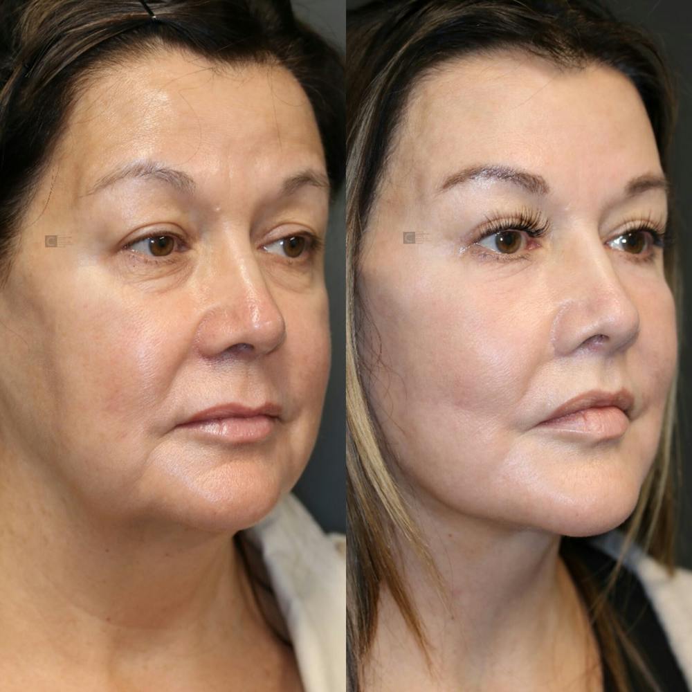 ÔPTIMized Facial Fat Transfer Before & After Gallery - Patient 123023724 - Image 3