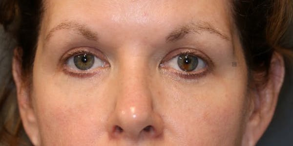ÔPTIMized Facial Fat Transfer Before & After Gallery - Patient 123023752 - Image 5