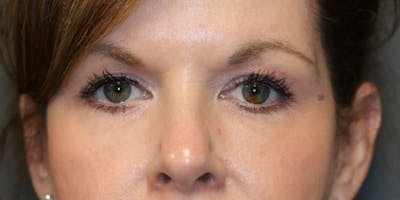 ÔPTIMized Facial Fat Transfer Before & After Gallery - Patient 123023752 - Image 6