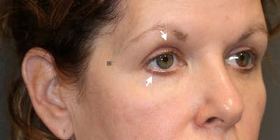 ÔPTIMized Facial Fat Transfer Before & After Gallery - Patient 123023752 - Image 1