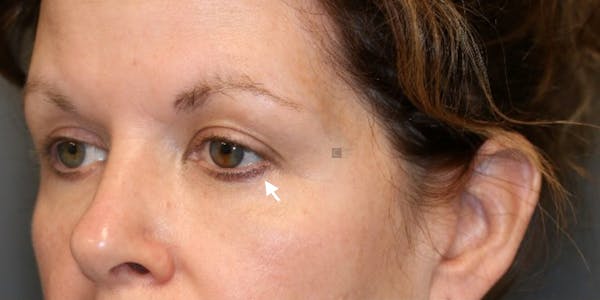 ÔPTIMized Facial Fat Transfer Before & After Gallery - Patient 123023752 - Image 3