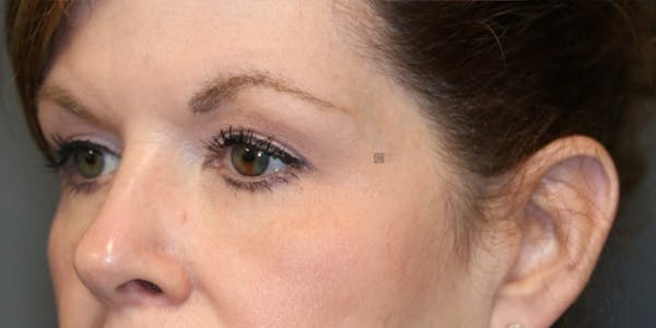 ÔPTIMized Facial Fat Transfer Before & After Gallery - Patient 123023752 - Image 4