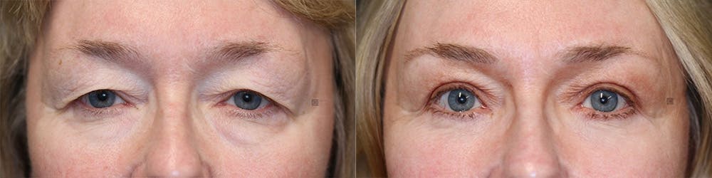 EnigmaLift - Brow Lift Before & After Gallery - Patient 144408902 - Image 1