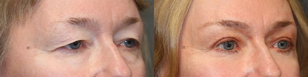 EnigmaLift - Eye Bag Removal Before & After Gallery - Patient 144408906 - Image 2