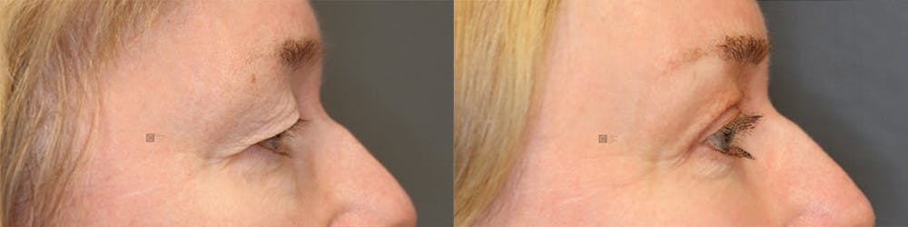 EnigmaLift - Brow Lift Before & After Gallery - Patient 144408902 - Image 3