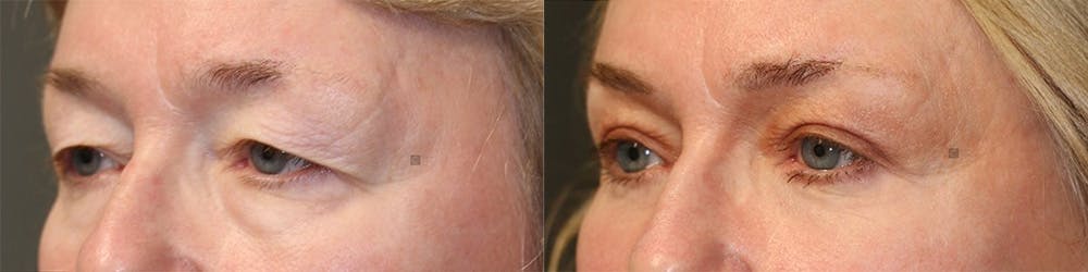 ÔPTIMized Facial Fat Transfer Before & After Gallery - Patient 144408904 - Image 4