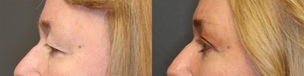 ÔPTIMized Facial Fat Transfer Before & After Gallery - Patient 144408904 - Image 5