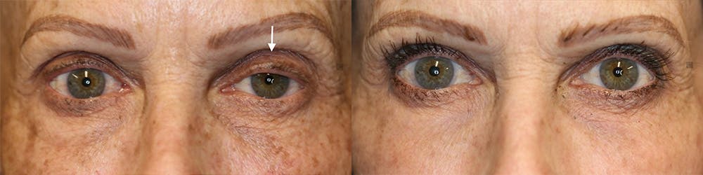  EnigmaLift - Upper Eyelid Surgery Before & After Gallery - Patient 144408910 - Image 1