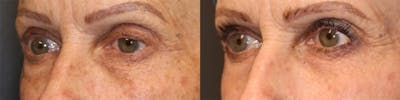  EnigmaLift - Upper Eyelid Surgery Before & After Gallery - Patient 144408910 - Image 2
