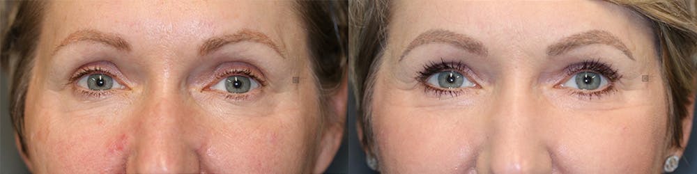  EnigmaLift - Upper Eyelid Surgery Before & After Gallery - Patient 144408931 - Image 1