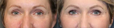 ÔPTIMized Facial Fat Transfer Before & After Gallery - Patient 144408933 - Image 1