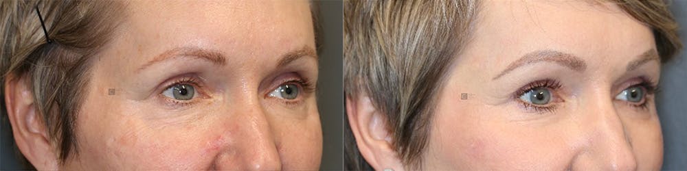  EnigmaLift - Upper Eyelid Surgery Before & After Gallery - Patient 144408931 - Image 2