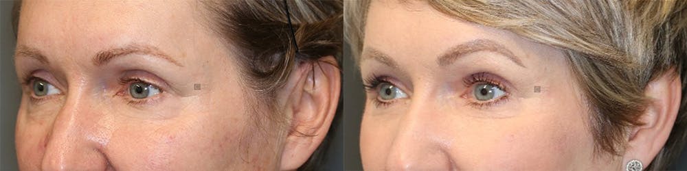 ÔPTIMized Facial Fat Transfer Before & After Gallery - Patient 144408933 - Image 3