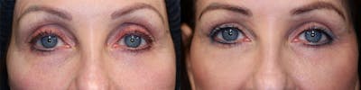 ÔPTIMized Facial Fat Transfer Before & After Gallery - Patient 144428157 - Image 1