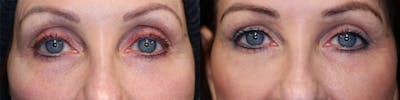  EnigmaLift - Upper Eyelid Surgery Before & After Gallery - Patient 144428150 - Image 1