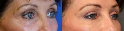  EnigmaLift - Upper Eyelid Surgery Before & After Gallery - Patient 144428150 - Image 2