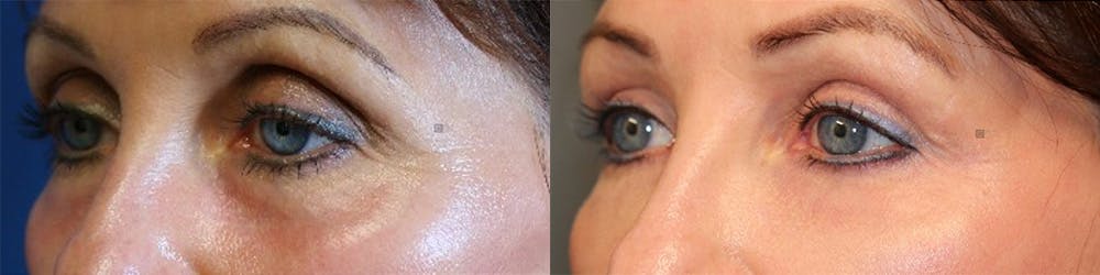  EnigmaLift - Upper Eyelid Surgery Before & After Gallery - Patient 144428150 - Image 3
