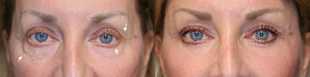 EnigmaLift - Brow Lift Before & After Gallery - Patient 144428206 - Image 1