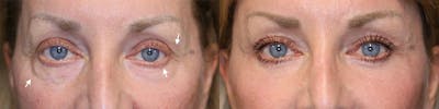 ÔPTIMized Facial Fat Transfer Before & After Gallery - Patient 144428208 - Image 1