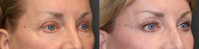  EnigmaLift - Upper Eyelid Surgery Before & After Gallery - Patient 144428203 - Image 2