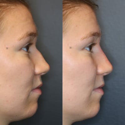 Non-Surgical Rhinoplasty Before & After Gallery - Patient 144428217 - Image 1