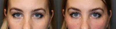 Dermal Fillers Before & After Gallery - Patient 144428260 - Image 1