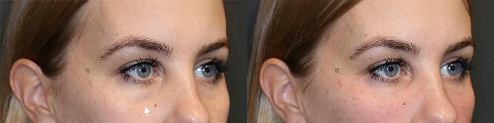 EnigmaLift - Eye Bag Removal Before & After Gallery - Patient 144428257 - Image 2