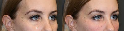 EnigmaLift - Eye Bag Removal Before & After Gallery - Patient 144428257 - Image 2