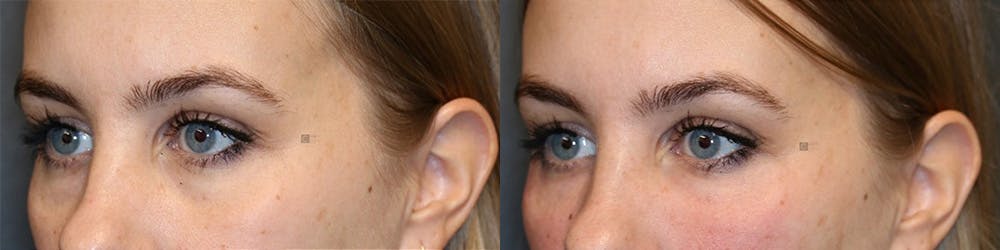 EnigmaLift - Eye Bag Removal Before & After Gallery - Patient 144428257 - Image 3