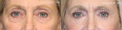 EnigmaLift - Eye Bag Removal Before & After Gallery - Patient 144428282 - Image 1