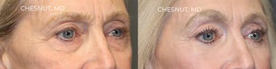 EnigmaLift - Eye Bag Removal Before & After Gallery - Patient 144428282 - Image 2