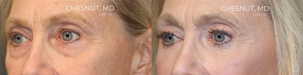 EnigmaLift - Eye Bag Removal Before & After Gallery - Patient 144428282 - Image 3