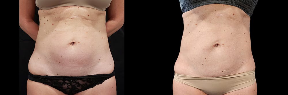 Coolsculpting Before & After Gallery - Patient 146736794 - Image 5
