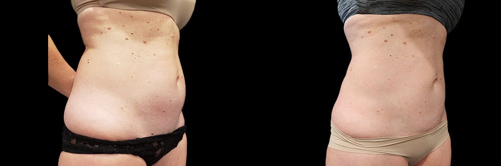 Coolsculpting Before & After Gallery - Patient 146736794 - Image 3