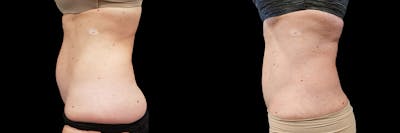 Coolsculpting Before & After Gallery - Patient 146736794 - Image 1