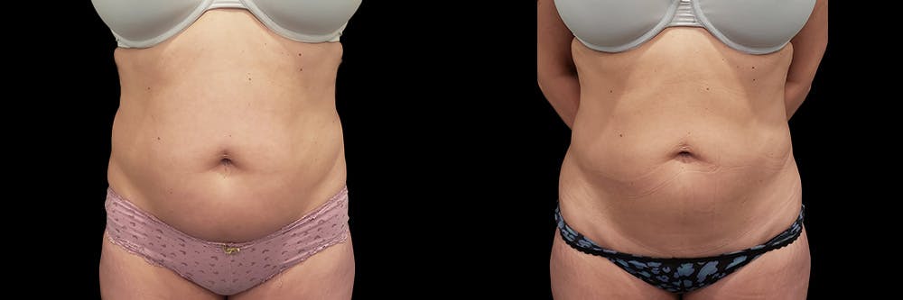 Coolsculpting Before & After Gallery - Patient 146736797 - Image 5
