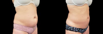 Coolsculpting Before & After Gallery - Patient 146736797 - Image 2