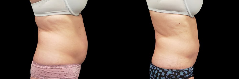 Coolsculpting Before & After Gallery - Patient 146736797 - Image 3