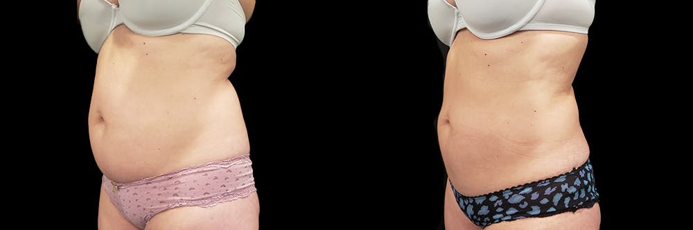 Coolsculpting Before & After Gallery - Patient 146736797 - Image 4