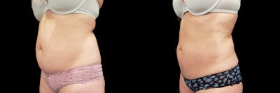 Coolsculpting Before & After Gallery - Patient 146736797 - Image 4