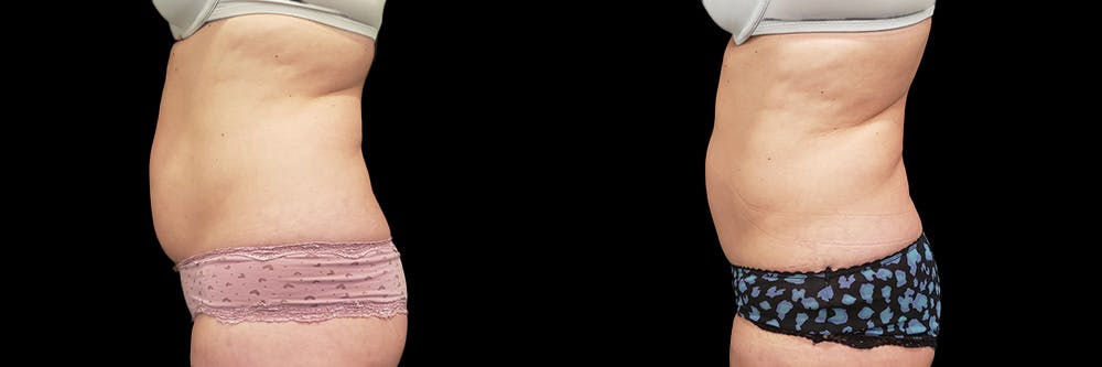 Coolsculpting Before & After Gallery - Patient 146736797 - Image 1