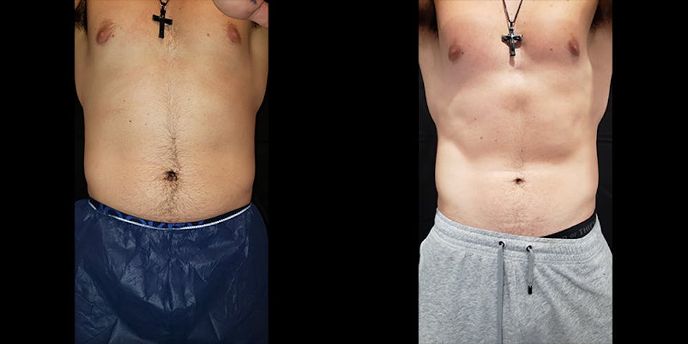Coolsculpting Before & After Gallery - Patient 146866799 - Image 1