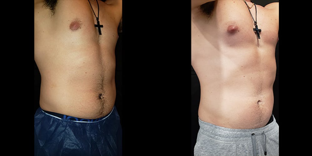 Coolsculpting Before & After Gallery - Patient 146866799 - Image 2