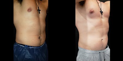 Coolsculpting Before & After Gallery - Patient 146866799 - Image 2